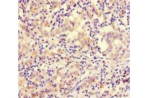 Immunohistochemistry of paraffin-embedded human lung cancer using ABIN7171083 at dilution of 1:100 (SMARCE1 Antikörper  (AA 20-243))