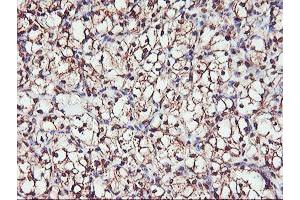 Immunohistochemical staining of paraffin-embedded Carcinoma of Human kidney tissue using anti-SERPINB6 mouse monoclonal antibody.
