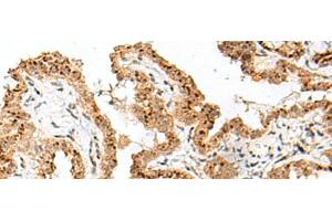 Immunohistochemistry of paraffin-embedded Human thyroid cancer tissue using FAM84B Polyclonal Antibody at dilution of 1:70(x200) (FAM84B Antikörper)