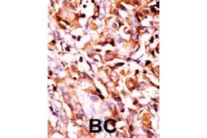 Formalin-fixed and paraffin-embedded human cancer tissue reacted with BAD (phospho S99) polyclonal antibody  which was peroxidase-conjugated to the secondary antibody followed by AEC staining.