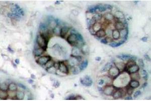 Immunohistochemistry (IHC) analyzes of GAP43 antibody in paraffin-embedded human breast carcinoma tissue. (GAP43 Antikörper)