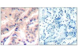 Immunohistochemical analysis of paraffin-embedded human lung carcinomatissue using eIF4B(Phospho-Ser422) Antibody(left) or the same antibody preincubated with blocking peptide(right). (EIF4B Antikörper  (pSer422))