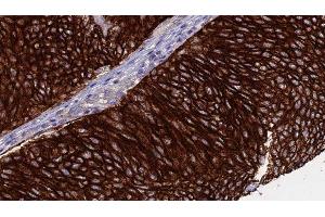 ABIN6276368 at 1/100 staining Human urothelial cancer tissue by IHC-P. (CD40 Ligand Antikörper  (Internal Region))