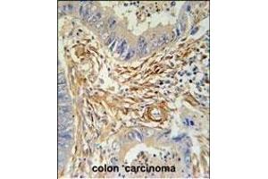 PRB2 Antibody (C-term) (ABIN6244055 and ABIN6578967) immunohistochemistry analysis in formalin fixed and paraffin embedded human colon carcinoma followed by peroxidase conjugation of the secondary antibody and DAB staining. (PRB2 Antikörper  (C-Term))