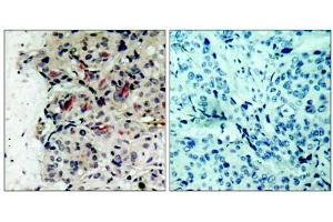 Immunohistochemical analysis of paraffin-embedded human breast carcinoma tissue using JAK1 (Ab-1022) antibody (E021119). (JAK1 Antikörper)