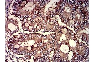 Immunohistochemical analysis of paraffin-embedded rectum cancer tissues using CD46 mouse mAb with DAB staining.