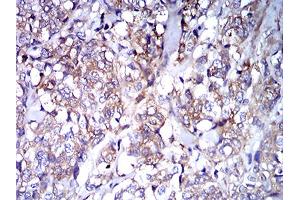 Immunohistochemical analysis of paraffin-embedded breast cancer tissues using IghA1 mouse mAb with DAB staining. (IGHA1 Antikörper  (AA 207-353))