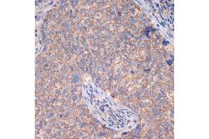 Immunohistochemistry of paraffin-embedded human breast cancer using CTNN Rabbit mAb (ABIN7266135) at dilution of 1:100 (40x lens). (CTNNA3 Antikörper)