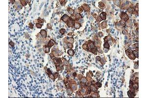Immunohistochemical staining of paraffin-embedded Carcinoma of Human lung tissue using anti-DPP10 mouse monoclonal antibody. (DPP10 Antikörper)