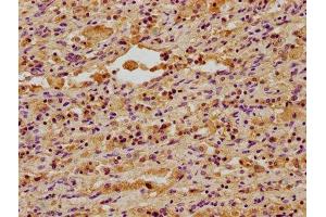 IHC image of ABIN7150498 diluted at 1:400 and staining in paraffin-embedded human lung cancer performed on a Leica BondTM system. (DNAJA3 Antikörper  (AA 86-184))