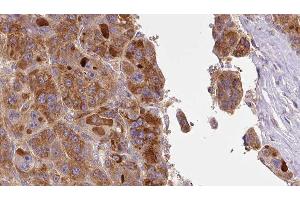 ABIN6277401 at 1/100 staining Human liver cancer tissue by IHC-P. (SLC16A1 Antikörper  (Internal Region))
