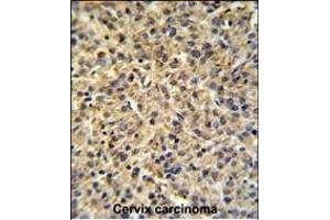 TPRGL Antibody (N-term) (ABIN651274 and ABIN2840164) IHC analysis in formalin fixed and paraffin embedded human cervix carcinoma tissue followed by peroxidase conjugation of the secondary antibody and DAB staining. (TPRG1L Antikörper  (N-Term))