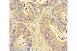 Immunohistochemistry of paraffin-embedded human colon cancer using ABIN7150594 at dilution of 1:100 (RPN1 Antikörper  (AA 44-427))