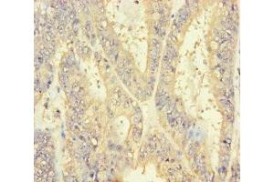 Immunohistochemistry of paraffin-embedded human endometrial cancer using ABIN7151338 at dilution of 1:100 (INSL4 Antikörper  (AA 30-139))