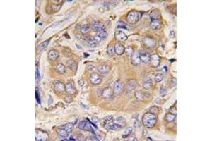 Formalin-fixed and paraffin-embedded human breast carcinoma tissue reacted with HSPB1 Antibody , which was peroxidase-conjugated to the secondary antibody, followed by DAB staining. (HSP27 Antikörper  (Ser78))