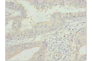 Immunohistochemistry of paraffin-embedded human endometrial cancer using ABIN7144060 at dilution of 1:100 (ZFAND3 Antikörper  (AA 1-227))