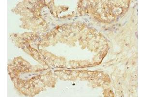 Immunohistochemistry of paraffin-embedded human prostate cancer using ABIN7162350 at dilution of 1:100 (GPR68 Antikörper  (AA 276-365))