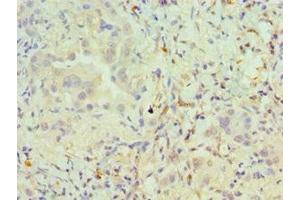 Immunohistochemistry of paraffin-embedded human lung cancer using ABIN7162504 at dilution of 1:100 (PAX6 Antikörper  (AA 1-300))