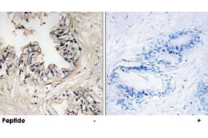 Immunohistochemistry analysis of paraffin-embedded human breast carcinoma tissue using MRPS36 polyclonal antibody . (MRPS36 Antikörper)