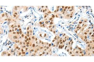 Immunohistochemistry of paraffin-embedded Human lung cancer using APPL1 Polyclonal Antibody at dilution of 1:70