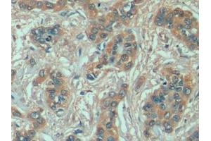 Detection of HSPA1A in Human Liver cancer Tissue using Anti-Heat Shock 70 kDa Protein 1A (HSPA1A) Monoclonal Antibody (HSP70 1A Antikörper  (AA 285-641))