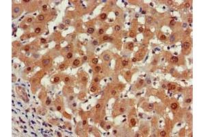 Immunohistochemistry of paraffin-embedded human liver cancer using ABIN7164960 at dilution of 1:100 (PSMA5 Antikörper  (AA 124-180))