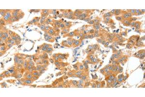 Immunohistochemistry of paraffin-embedded Human breast cancer tissue using ADAMTS18 Polyclonal Antibody at dilution 1:30