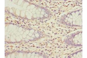 Immunohistochemistry of paraffin-embedded human colon cancer using ABIN7163881 at dilution of 1:100