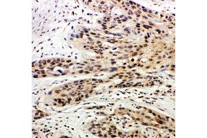 Anti-Caspase-14 antibody, IHC(P) IHC(P): Human Oesophagus Squama Cancer Tissue
