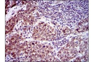 Immunohistochemical analysis of paraffin-embedded breast cancer tissues using CLGN mouse mAb with DAB staining. (Calmegin Antikörper  (AA 249-405))