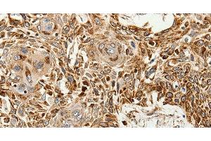 Immunohistochemistry of paraffin-embedded Human esophagus cancer tissue using SLC9A7 Polyclonal Antibody at dilution 1:60 (NHE7 Antikörper)