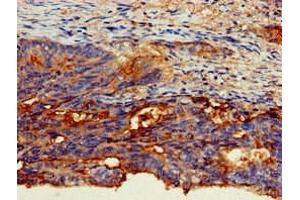 Immunohistochemistry of paraffin-embedded human colon cancer using ABIN7146803 at dilution of 1:100 (CEACAM6 Antikörper  (AA 35-320))