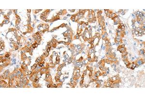 Immunohistochemistry of paraffin-embedded Human thyroid cancer using ACY3 Polyclonal Antibody at dilution of 1:35 (Aminoacylase 3 Antikörper)