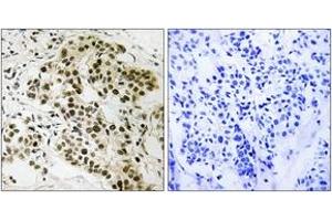 Immunohistochemistry analysis of paraffin-embedded human breast carcinoma tissue, using Retinoblastoma (Ab-252) Antibody. (Retinoblastoma Protein (Rb) Antikörper  (AA 221-270))
