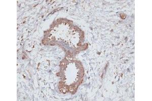 Immunohistochemistry of paraffin-embedded Human breast using TGFBR2 Polyclonal Antibody at dilution of 1:100 (40x lens). (TGFBR2 Antikörper)