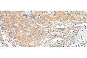 Immunohistochemistry of paraffin-embedded Human cervical cancer tissue using SLC6A9 Polyclonal Antibody at dilution of 1:25(x200) (GLYT1 Antikörper)