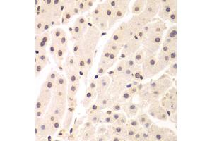Immunohistochemistry of paraffin-embedded human liver cancer using UHRF2 antibody. (UHRF2 Antikörper)