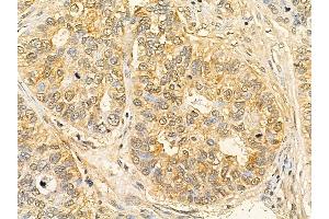 MLL5 Mouse Monoclonal Antibody at 1/100 staining human lung cancer by IHC-P.