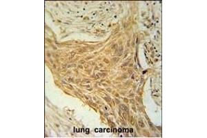 CSAG2 Antibody (N-term) (ABIN651616 and ABIN2840327) immunohistochemistry analysis in formalin fixed and paraffin embedded human lung carcinoma followed by peroxidase conjugation of the secondary antibody and DAB staining. (CSAG2 Antikörper  (N-Term))