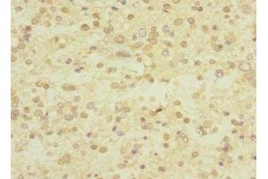 Immunohistochemistry of paraffin-embedded human glioma using ABIN7174375 at dilution of 1:100 (UBE4A Antikörper  (AA 797-1066))