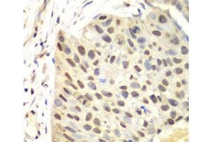 Immunohistochemistry of paraffin-embedded Human lung cancer using FEN1 Polyclonal Antibody at dilution of 1:100 (40x lens). (FEN1 Antikörper)