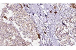 ABIN6279821 at 1/100 staining Human Melanoma tissue by IHC-P. (CCL1 Antikörper  (Internal Region))
