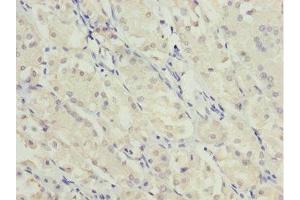 Immunohistochemistry of paraffin-embedded human gastric cancer using ABIN7174959 at dilution of 1:100 (MYO5C Antikörper  (AA 270-420))