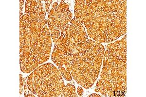 IHC staining of melanoma tissue (10X) with Tyrosinase antibody (T311). (TYR Antikörper)