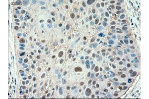 Immunohistochemical staining of paraffin-embedded Adenocarcinoma of colon using anti-PTCH1 (ABIN2452537) mouse monoclonal antibody. (Patched 1 Antikörper  (AA 122-436))