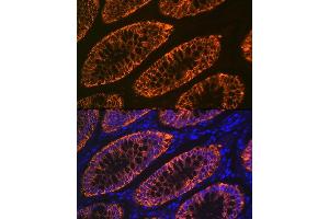 Immunofluorescence analysis of human colon carcinoma using GP Rabbit mAb (ABIN1682863, ABIN3017875, ABIN3017876 and ABIN7101532) at dilution of 1:100 (40x lens). (GPA33 Antikörper)