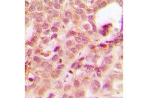 Immunohistochemical analysis of ABL1 staining in human breast cancer formalin fixed paraffin embedded tissue section. (ABL1 Antikörper  (N-Term))