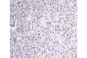 IHC-P analysis of Human Glioma Tissue, with DAB staining. (APOA1 Antikörper  (AA 122-267))