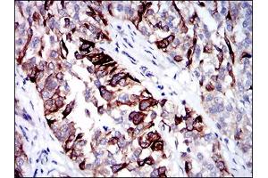 Immunohistochemical analysis of paraffin-embedded bladder cancer tissues using CK5 mouse mAb with DAB staining. (Cytokeratin 5 Antikörper  (AA 316-590))