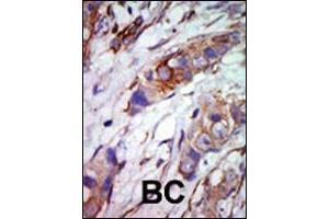 Formalin-fixed and paraffin-embedded human cancer tissue reacted with the primary antibody, which was peroxidase-conjugated to the secondary antibody, followed by AEC staining. (MAPK7 Antikörper  (C-Term))